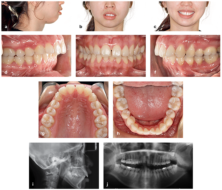 Align announces Invisalign package for malocclusions - Dentistry